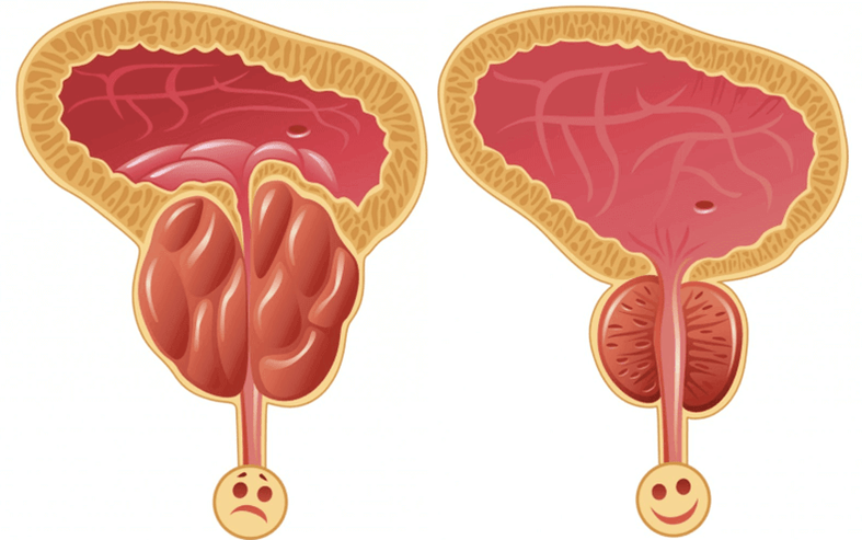 vzroki za težave s potenco pri moških